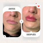 Antes-despues-labios-clinica-meu-2