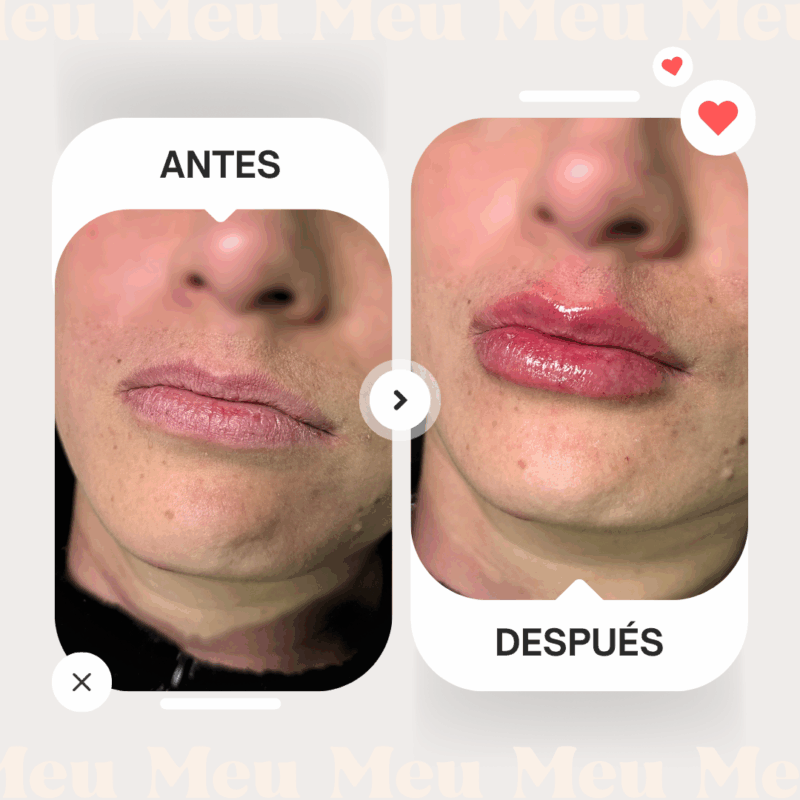 Antes-despues-labios-clinica-meu-2