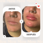 Antes-despues-labios-clinica-meu-3