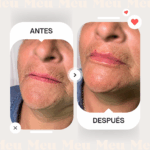 Antes-despues-labios-clinica-meu-4