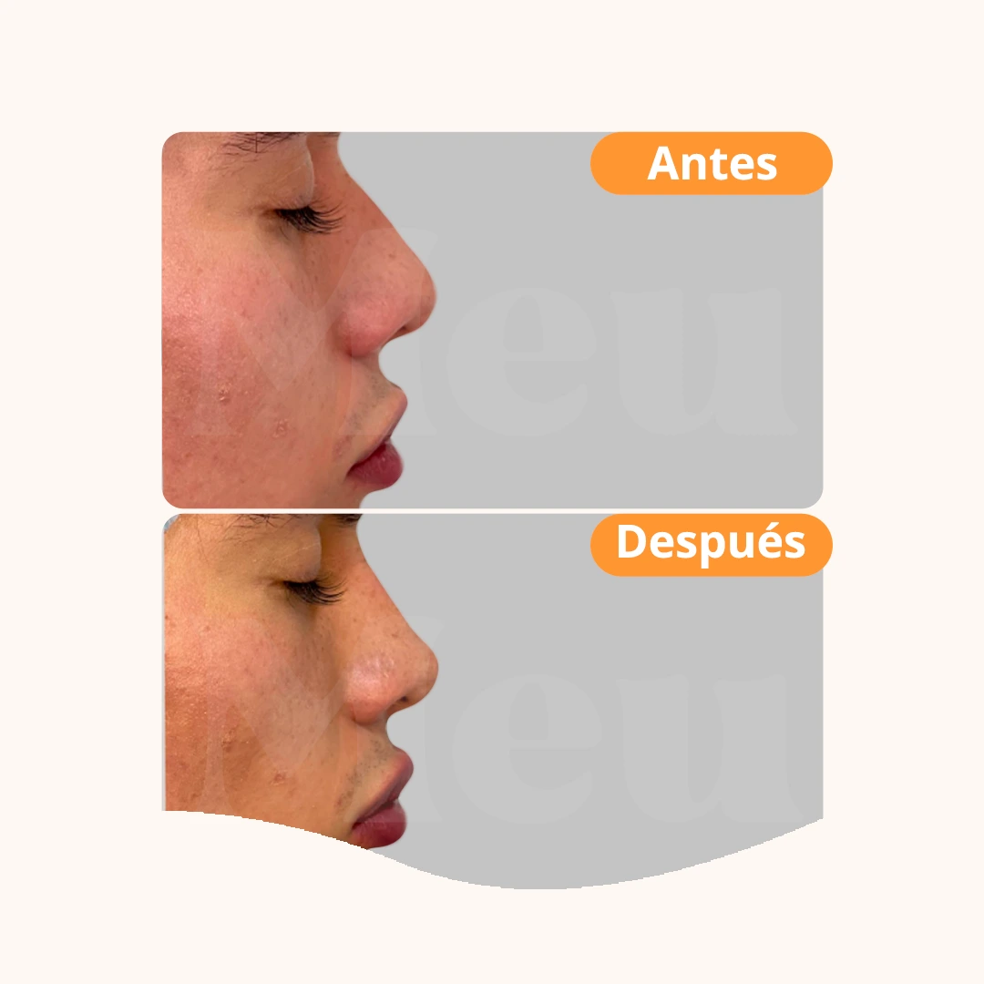 Antes y después: Rinomodelación + Aumento de labios