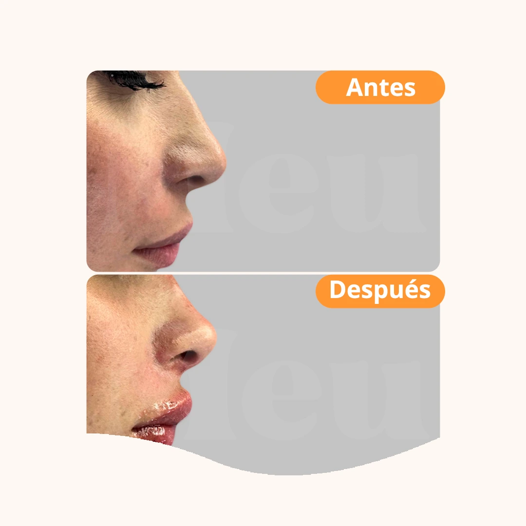 Antes y después: Rinomodelación + Aumento de labios