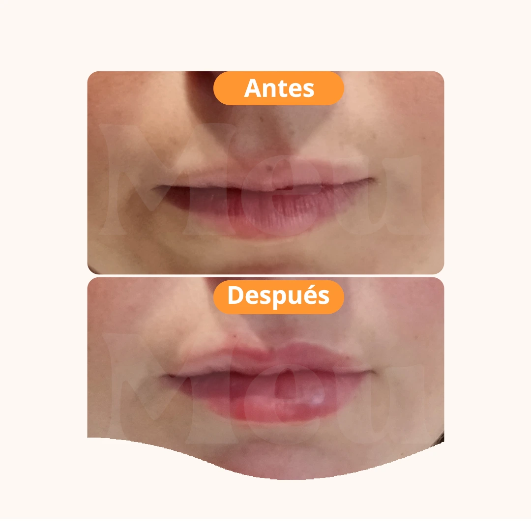 AUMENTO DE LABIOS ANTES Y DESPUÉS