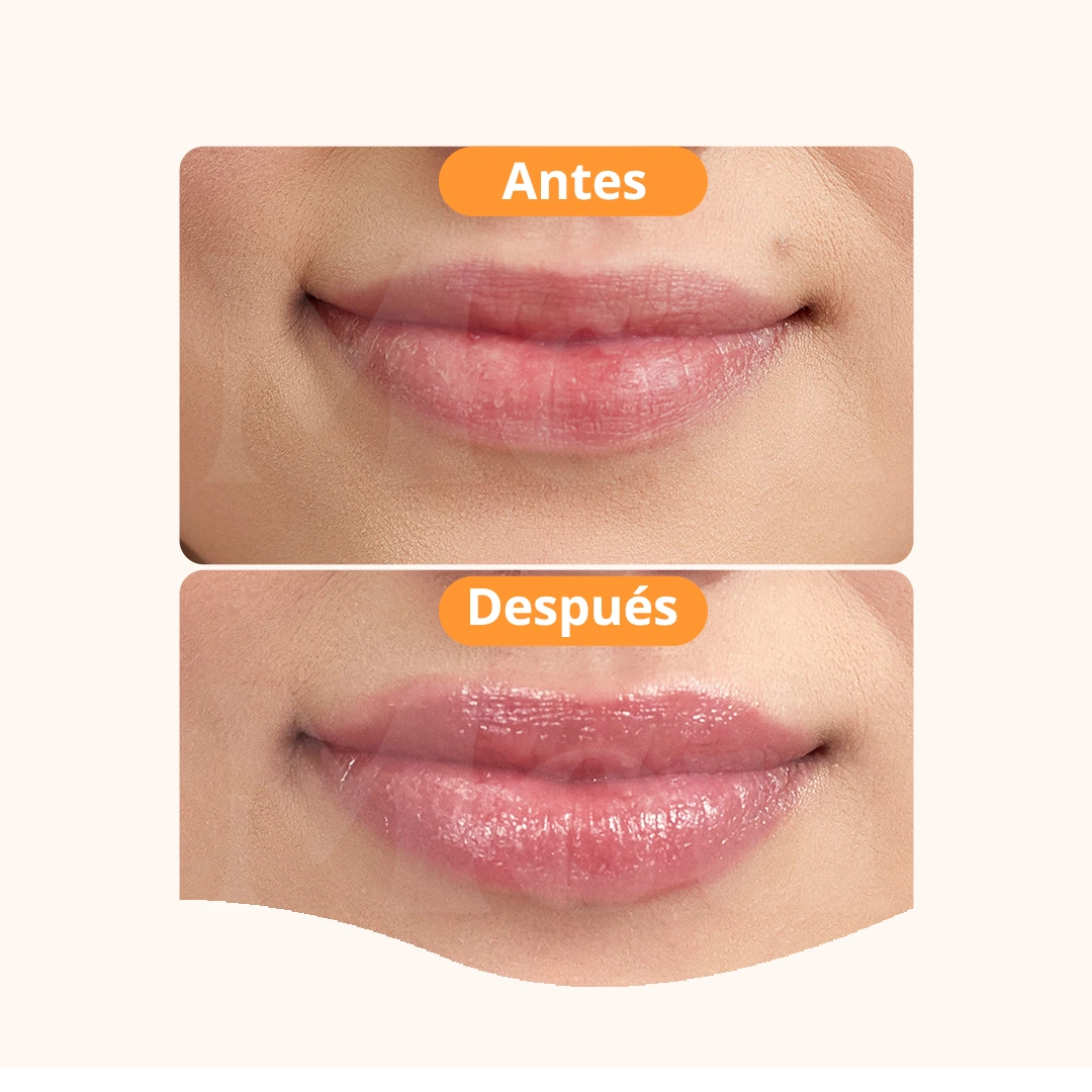 AUMENTO DE LABIOS ANTES Y DESPUÉS