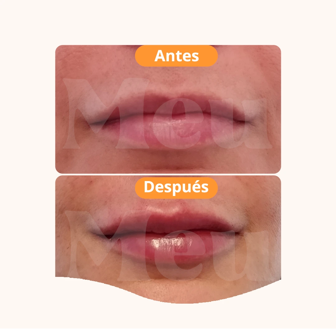 AUMENTO DE LABIOS ANTES Y DESPUÉS