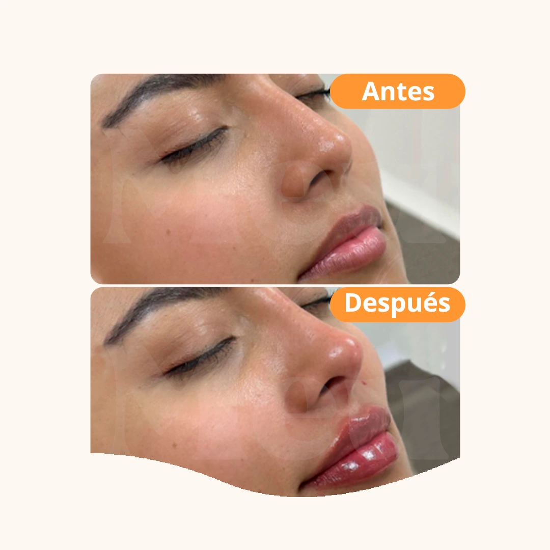 Antes y después: Rinomodelación + Aumento de labios