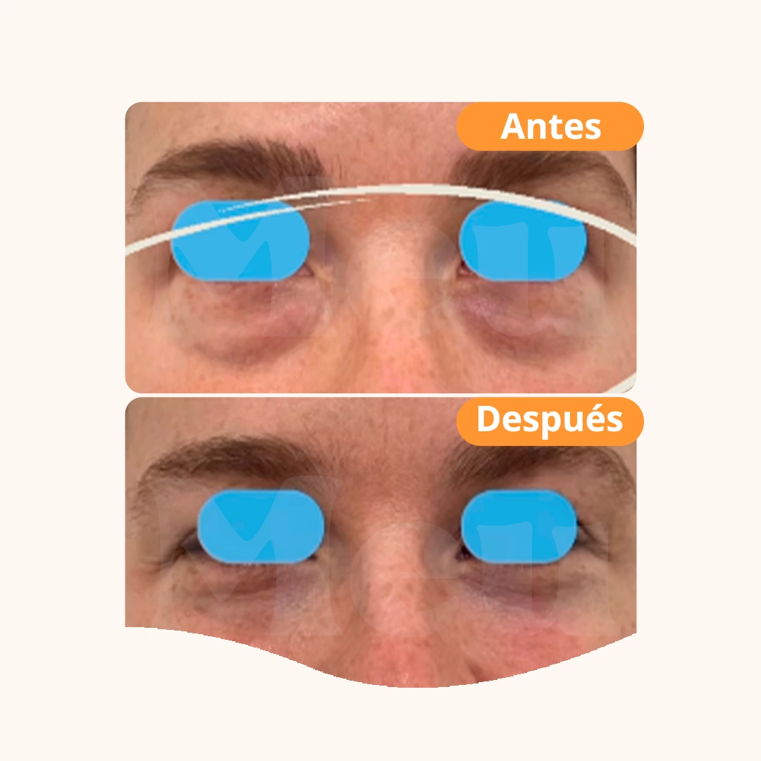 Antes y después: Relleno de ojeras