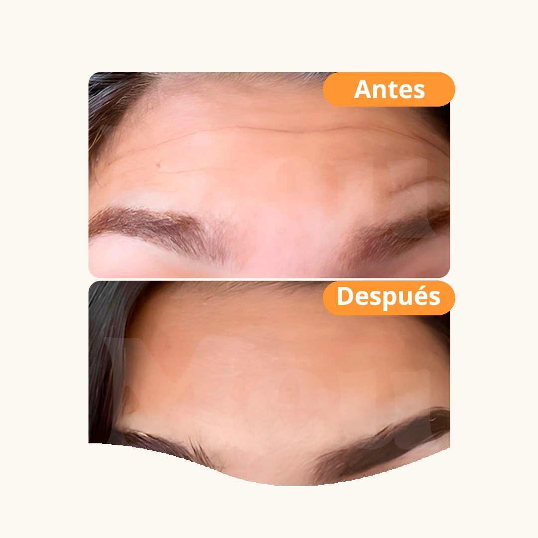 Baby Botox: antes y después del tratamiento