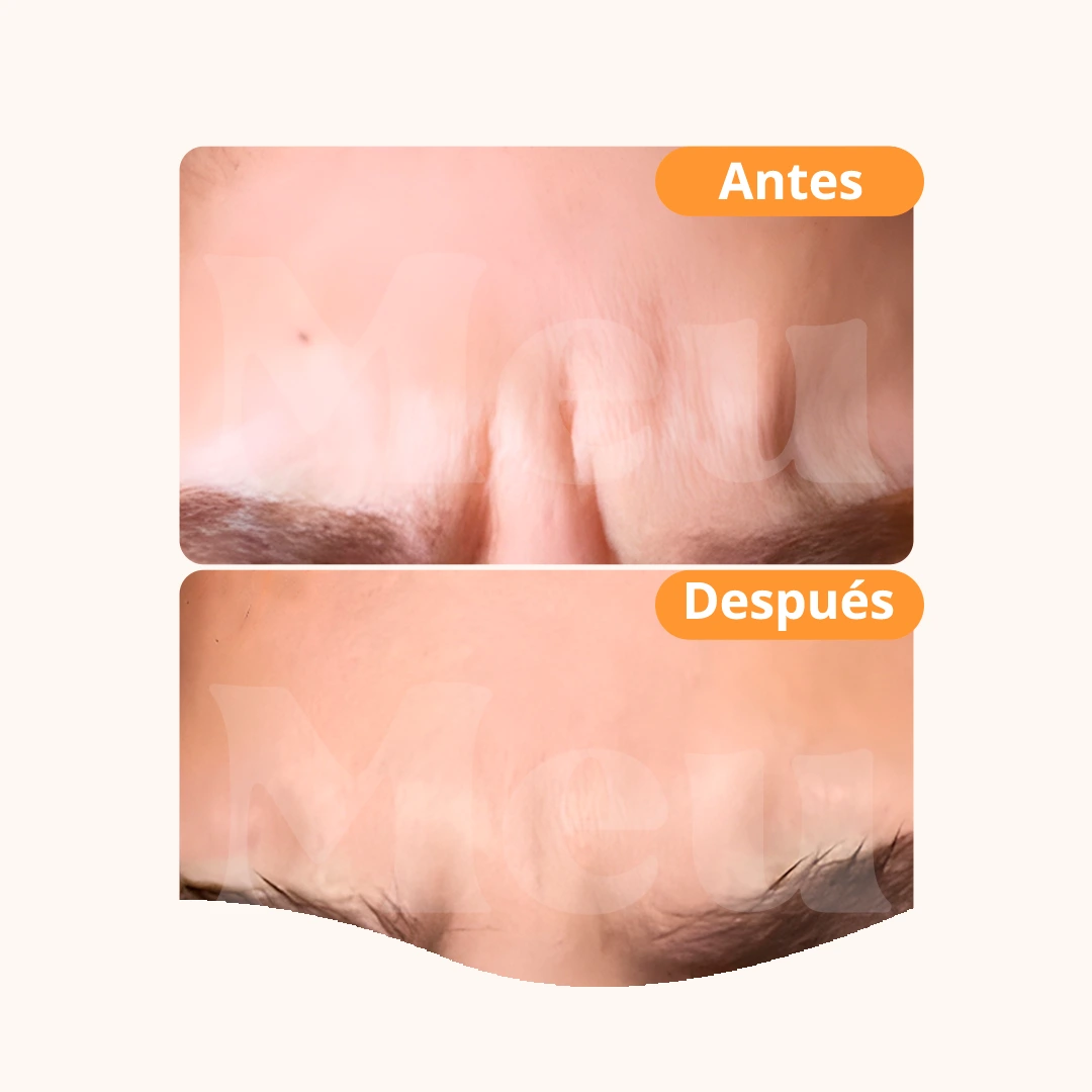 Baby Botox: antes y después del tratamiento