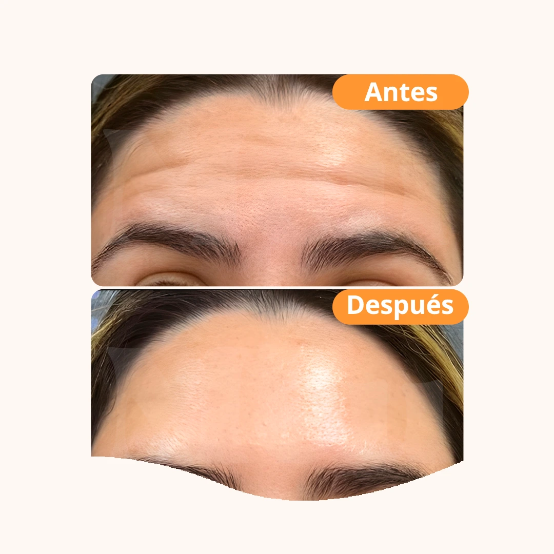 Baby Botox: antes y después del tratamiento