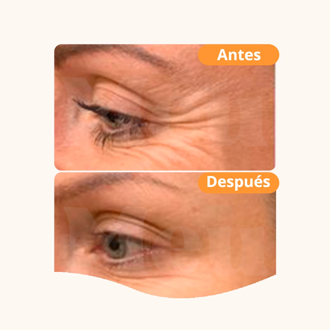 antes y después de un tratamiento de botox