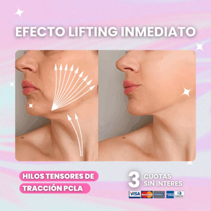 Hilos-de-Traccion-PCLA