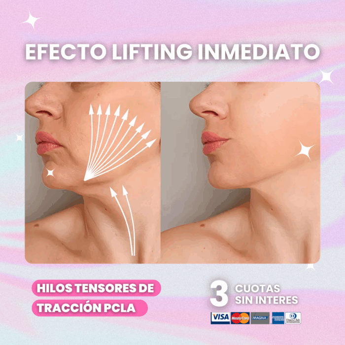 Hilos-de-Traccion-PCLA