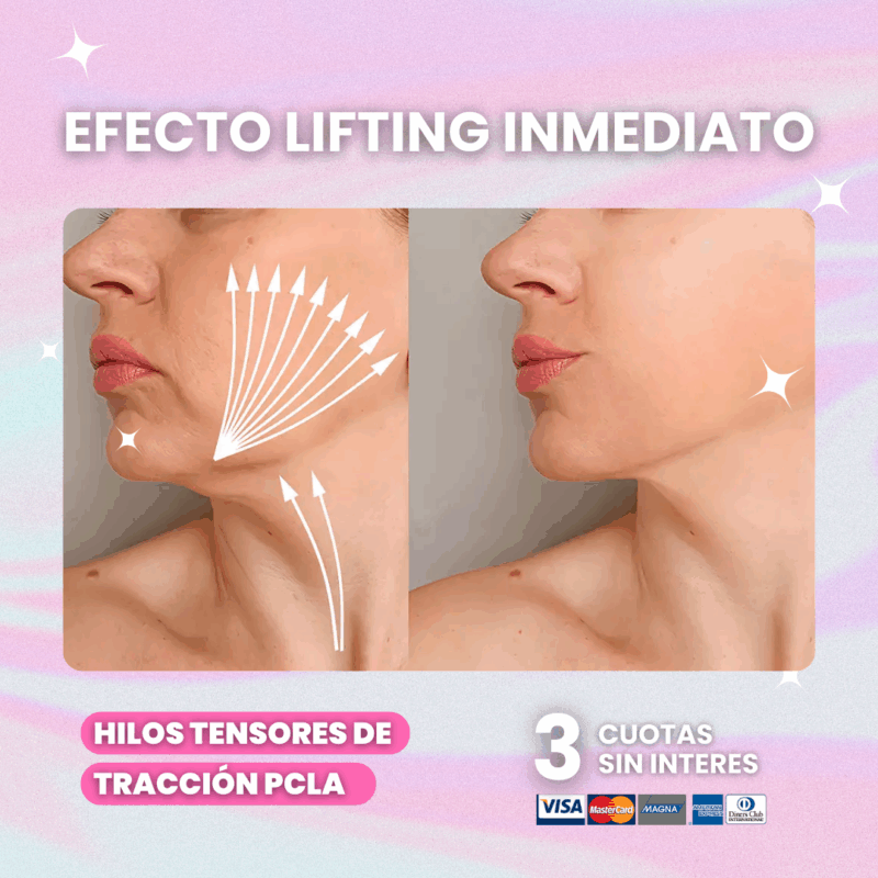 Hilos-de-Traccion-PCLA
