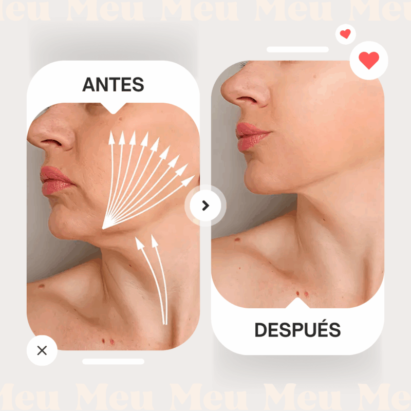 Hilos de Tracción PCLA-antes-y-despues-1-clinica-meu