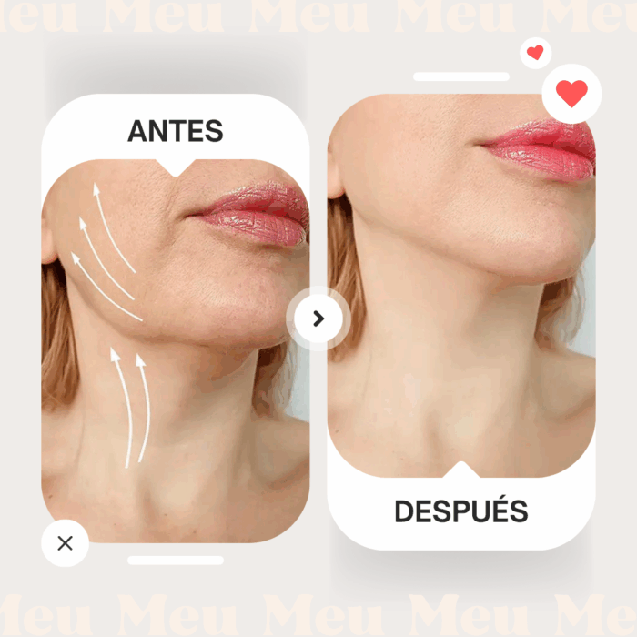 Hilos de Tracción PCLA-antes-y-despues-2-clinica-meu