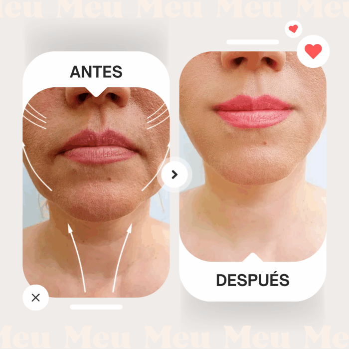 Hilos de Tracción PCLA-antes-y-despues-3-clinica-meu