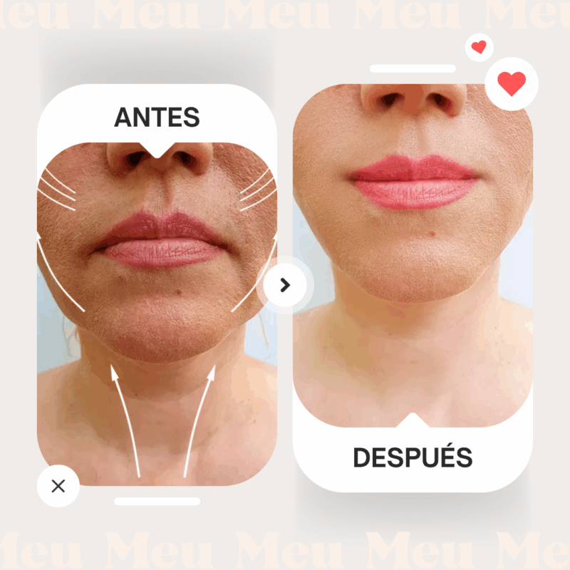 Hilos de Tracción PCLA-antes-y-despues-3-clinica-meu