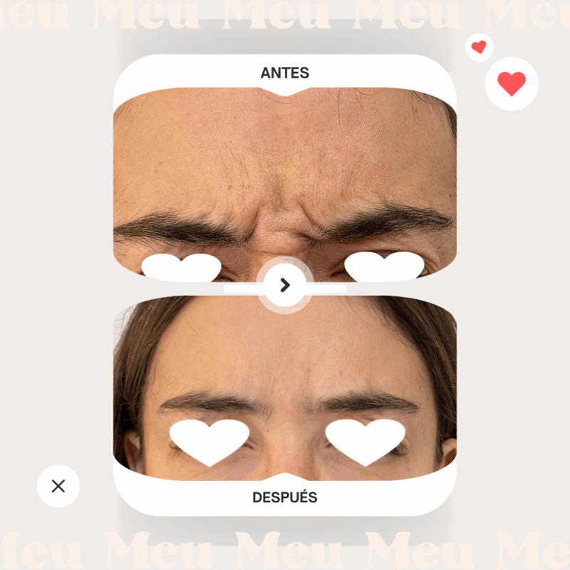 antes-y-despues-clinica-meu-toxina-botulinica-botox-reage-entrecejo