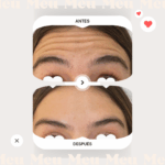 antes-y-despues-clinica-meu-toxina-botulinica-botox-reage-frente