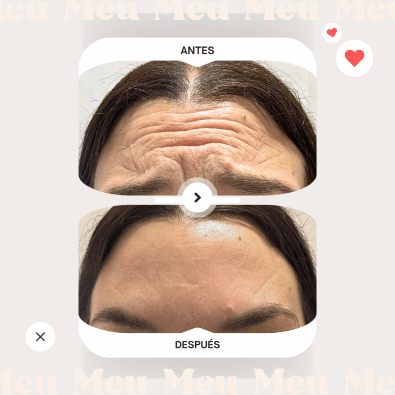 antes-y-despues-clinica-meu-toxina-botulinica-botox-reage-frente-2