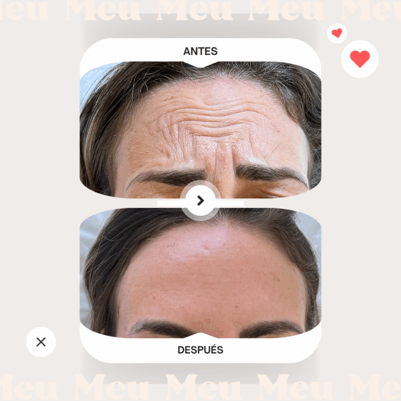 antes-y-despues-clinica-meu-toxina-botulinica-botox-reage-frente-3
