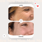 antes-y-despues-clinica-meu-toxina-botulinica-botox-reage-patas-de-gallo