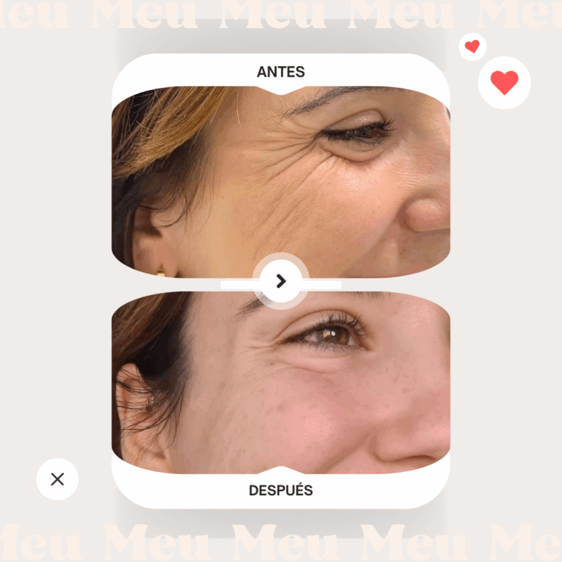 antes-y-despues-clinica-meu-toxina-botulinica-botox-reage-patas-de-gallo