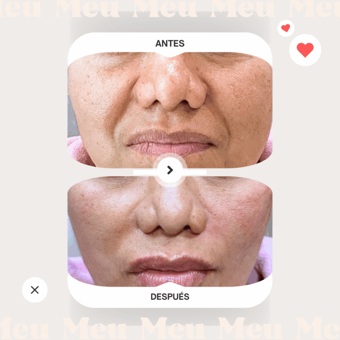 surco-nasogeniano-antesydespues-hilos-revitalizantes-2