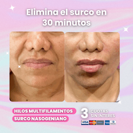 surco-nasogeniano-hilos-revitalizantes-clinica-meu-las-condes