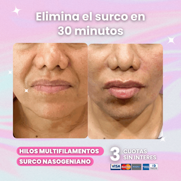 surco-nasogeniano-hilos-revitalizantes-clinica-meu-las-condes