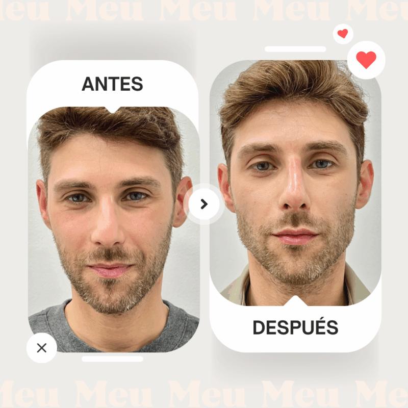 Contorno-mandibular-clinica-meu-hombre