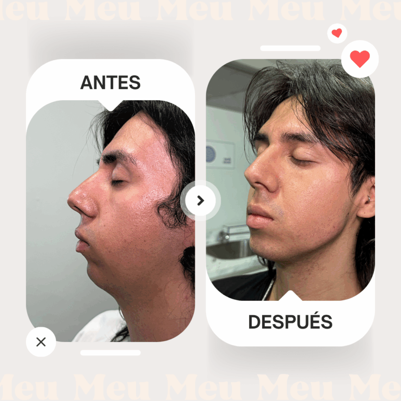 Contorno-mandibular-clinica-meu-hombre-masculinizacion-facial