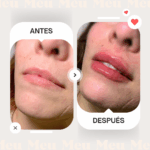 Antes-despues-labios-clinica-meu-1
