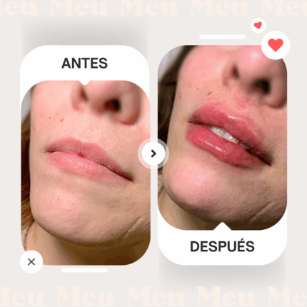 Antes-despues-labios-clinica-meu-1