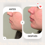 Antes-despues-menton-clinica-meu-1