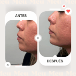 Antes-despues-menton-clinica-meu-2
