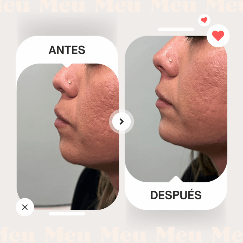 Antes-despues-menton-clinica-meu-2