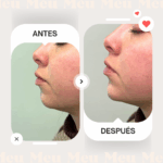 Antes-despues-menton-clinica-meu-3