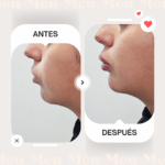 Antes-despues-menton-clinica-meu-4