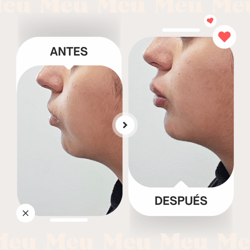 Antes-despues-menton-clinica-meu-4