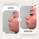 Antes-despues-rinomodelacion-clinica-meu-1