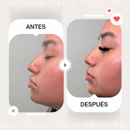 Antes-despues-rinomodelacion-clinica-meu-1