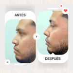 Antes-despues-rinomodelacion-clinica-meu-2