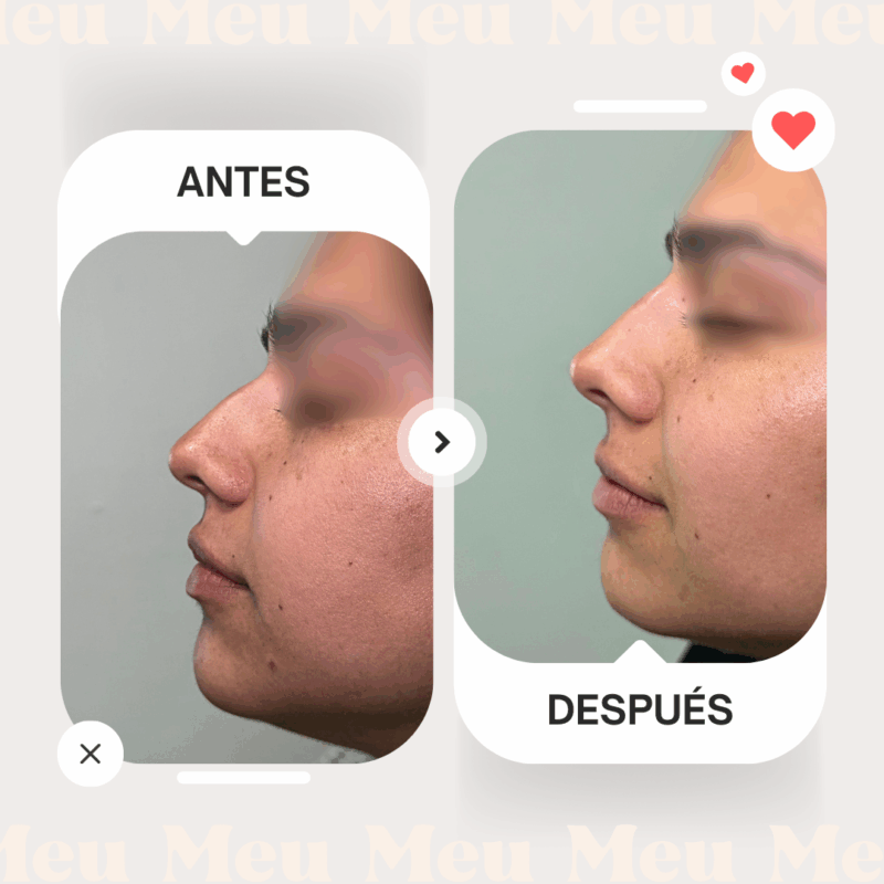 Antes-despues-rinomodelacion-clinica-meu-3