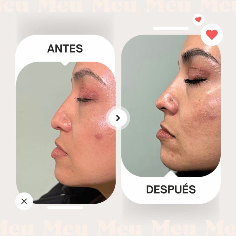 Antes-despues-rinomodelacion-clinica-meu-4